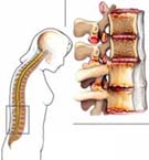Viêm cột sống dính khớp - Bệnh của nam giới trẻ tuổi